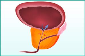 Enlarged prostate and pressure on the urethra