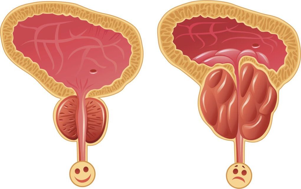 Healthy and diseased prostate