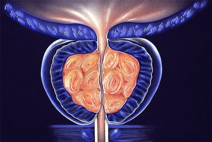 male prostate inflammation