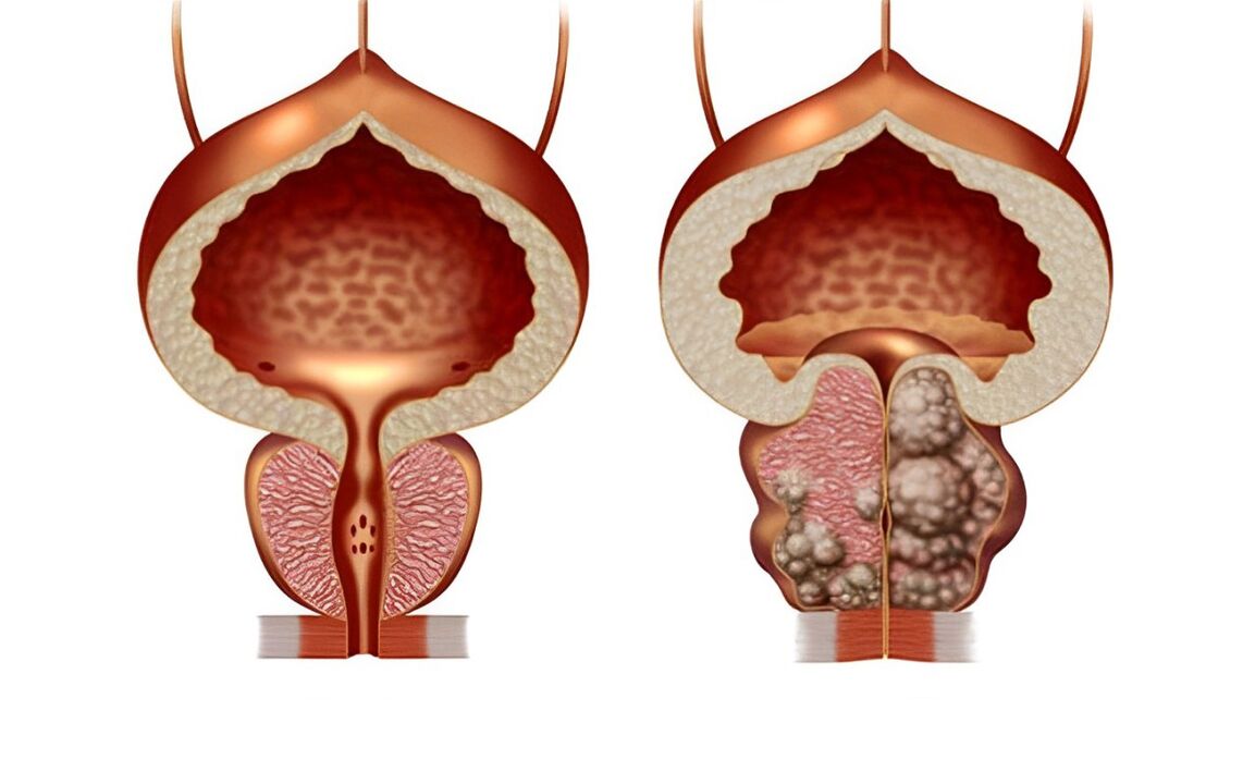 What does a prostate adenoma look like 