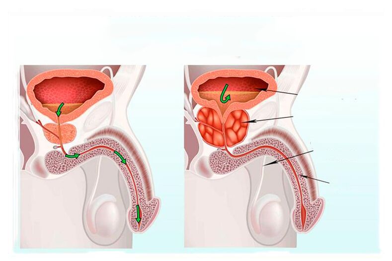 Standards and inflammation of the prostate