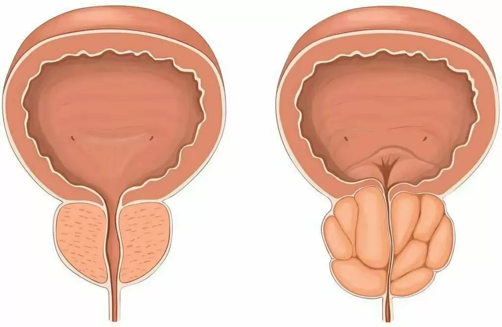 Normal prostate and prostate soreness