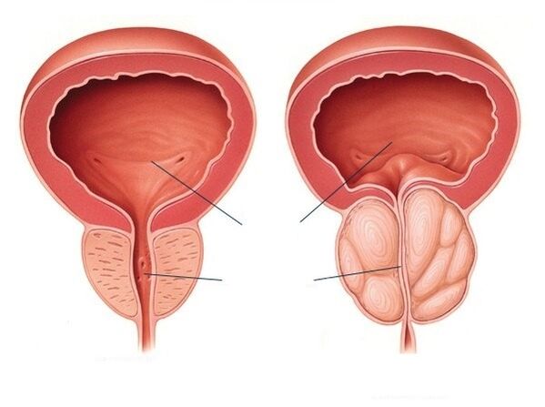 Normal and enlarged prostate