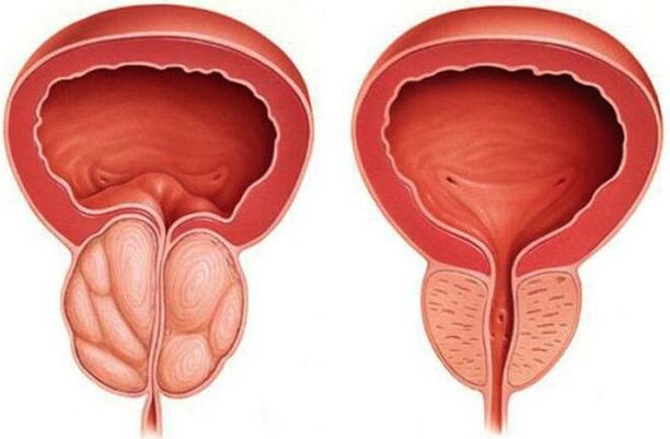 A healthy and inflamed prostate (with prostatitis)